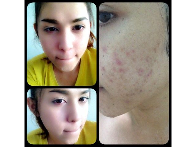 KISTA SONIYA BEAUTY SUPPLEMENT ANTI-ACNE PORES