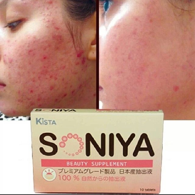 KISTA SONIYA BEAUTY SUPPLEMENT ANTI-ACNE PORES