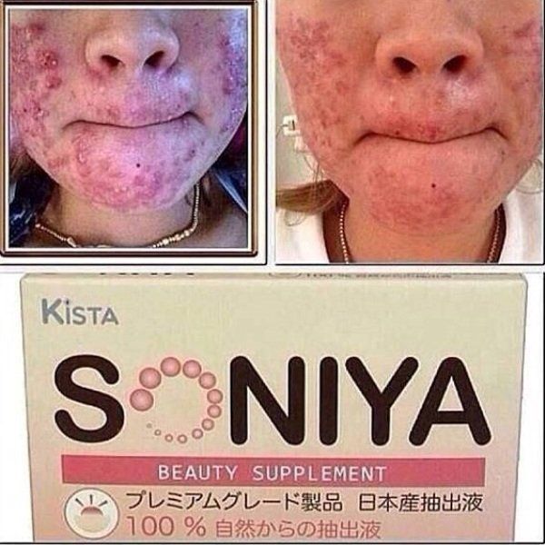 KISTA SONIYA BEAUTY SUPPLEMENT ANTI-ACNE PORES