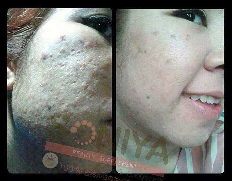 KISTA SONIYA BEAUTY SUPPLEMENT ANTI-ACNE PORES