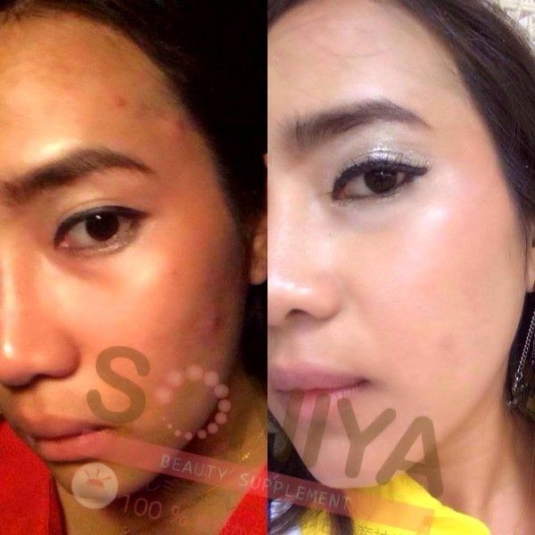 KISTA SONIYA BEAUTY SUPPLEMENT ANTI-ACNE PORES