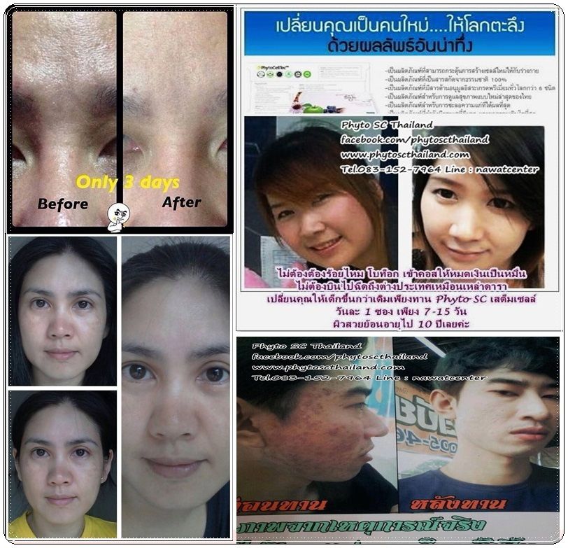 Stem Cell Phyto SC PhytoCellTec Anti Aging Apple Grape & All Natural Phyto SC (Dietary Supplement From Switzerland.)antioxidants + Whitening + Reduces Scars + Acne Pits + Dark Sports + Freckles.Have Been Tested By Halal, GMP. Antioxidants + Whitening + Reduces Scars + Acne Pits + Dark Sports + Freckles.