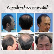 2x Miacare Clear Acne Patch Acne Dressing Patches for Acne Relief Day and Night