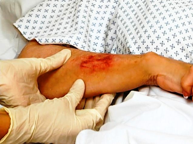 Stages Of Wound Healing Animated Gifs | Photobucket