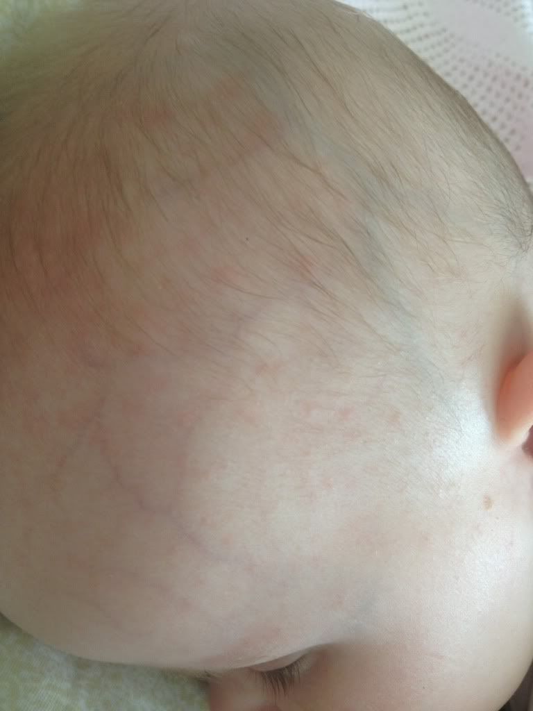 Red spots on babies scalp? - BabyCenter